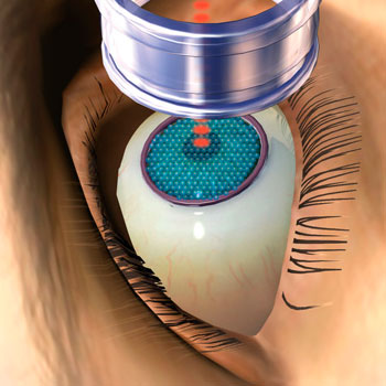 cirugia ojos