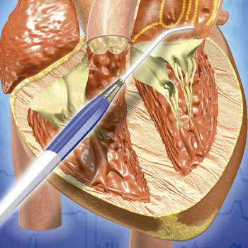 Fibrilación